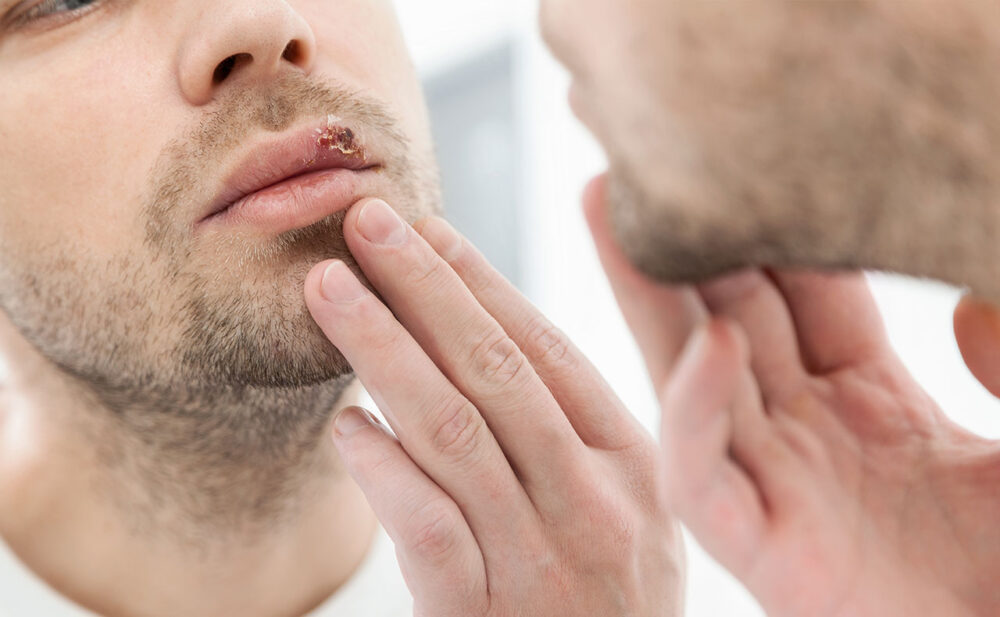 pickelinderlippe Das AntiPickel Portal