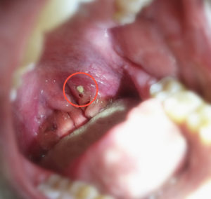 Zunge pickel der kleine auf weiße Zungenkrebs •
